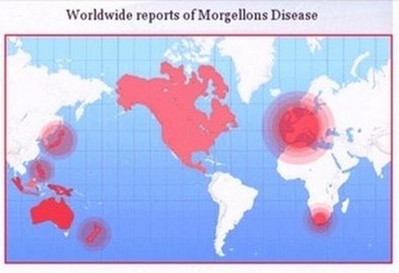 The Morgellons Research Foundation (MRF) - Morgellons ...