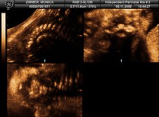 Zach's spinal Photos